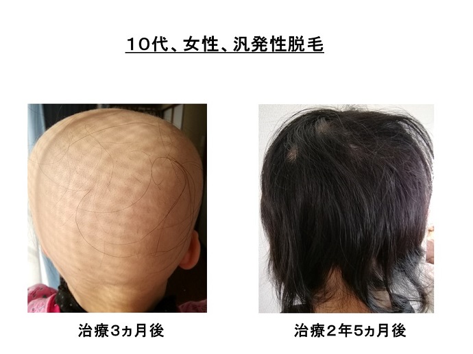 汎発性脱毛　病院